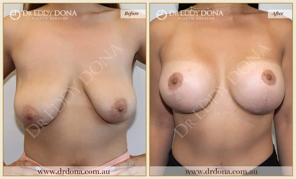 Dr Eddy Dona - Breast Lift and Implants Surgery - Before and After