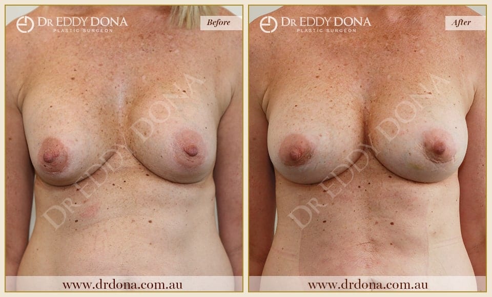 Dr Eddy Dona - Revision Breast Surgery - Before and After