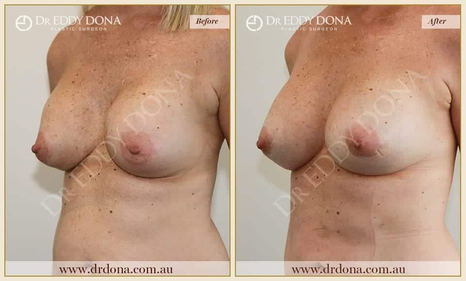 Dr Eddy Dona - Revision Breast Surgery - Before and After