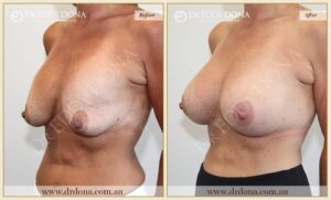 Dr Eddy Dona Revision Breast Surgery Before and After