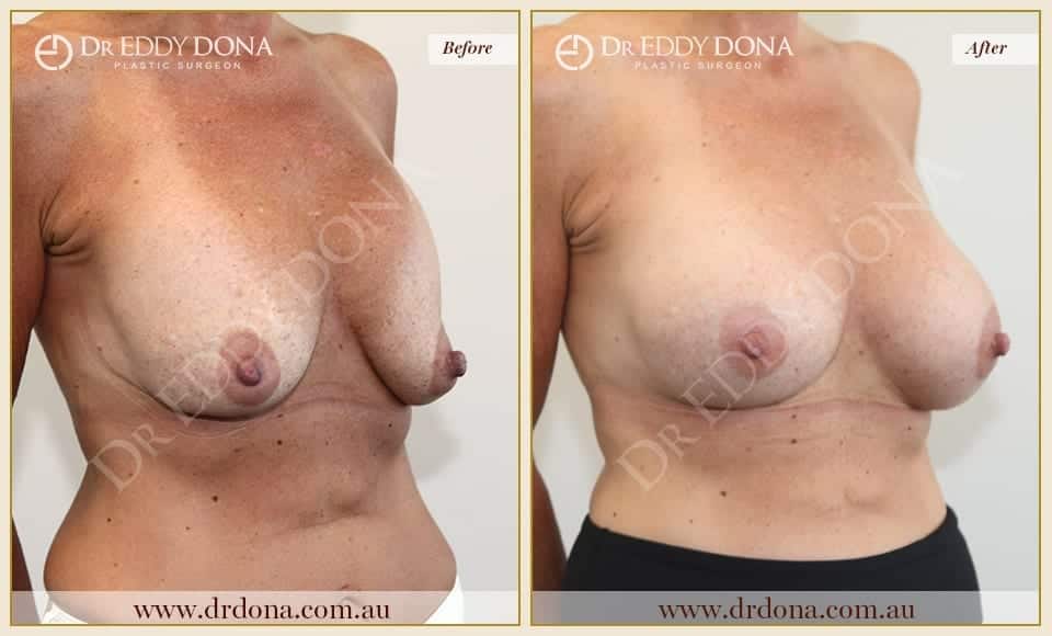 Dr Eddy Dona Revision Breast Surgery Before and After