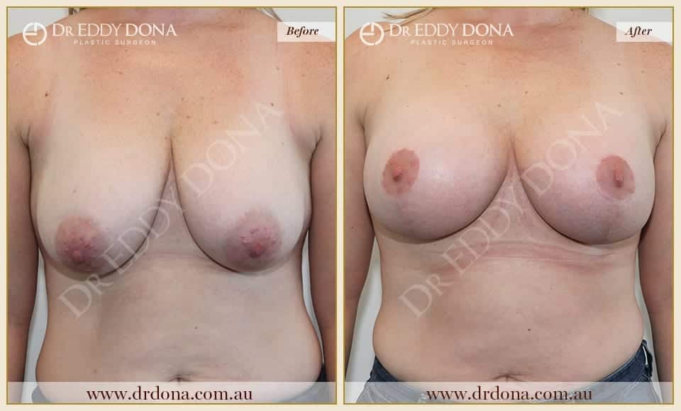 Dr Eddy Dona Breast Augmentation Two Stage Before and After