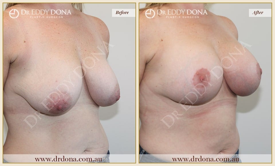 Dr Eddy Dona Breast Augmentation Two Stage Before and After