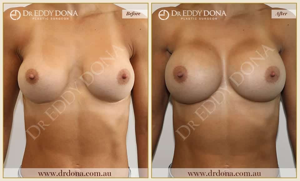 Dr Eddy Dona Breast Augmentation and Exchange of Implants Before and After