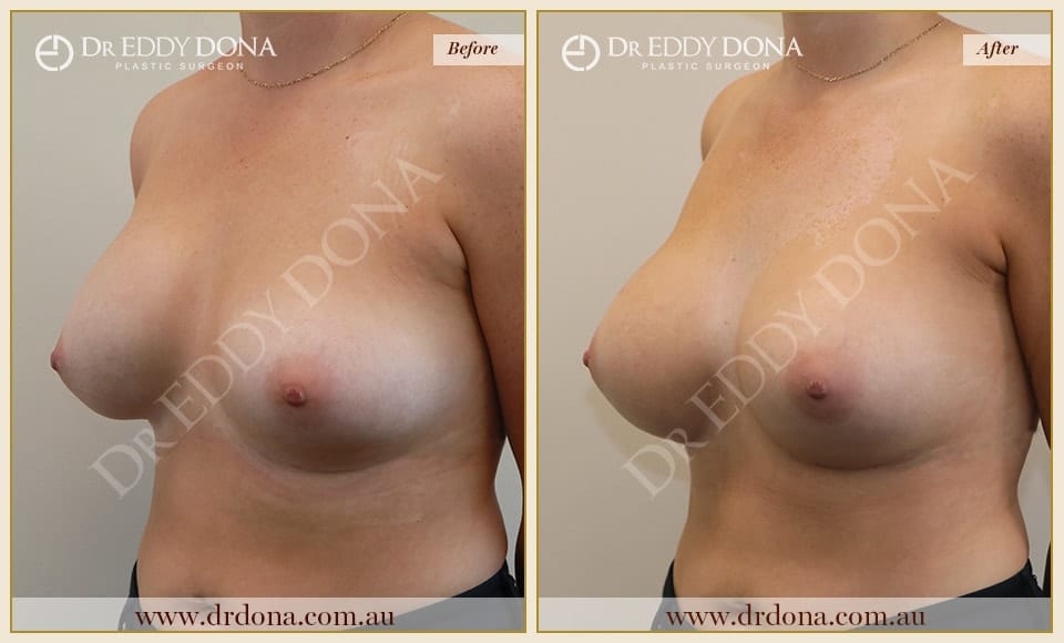 Dr Eddy Dona - Revision Breast Surgery - Before and After