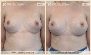 Dr Eddy Dona - Revision Breast Surgery Before and After