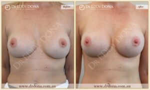 Dr Eddy Dona - Revision Breast Surgery Before and After