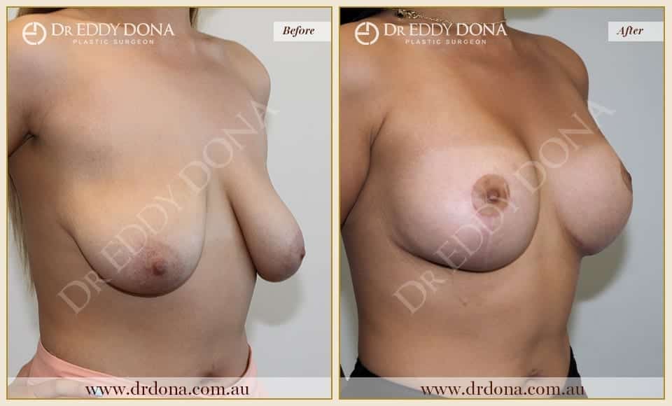 Dr Eddy Dona - Breast Lift and Implants Surgery - Before and After