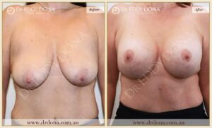 Dr Eddy Dona - Breast Lift and Implants Surgery - Before and After