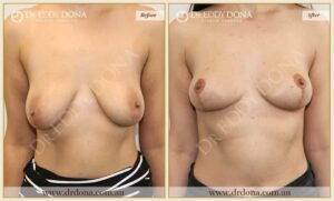 Dr Eddy Dona - Breast Lift - Before and After