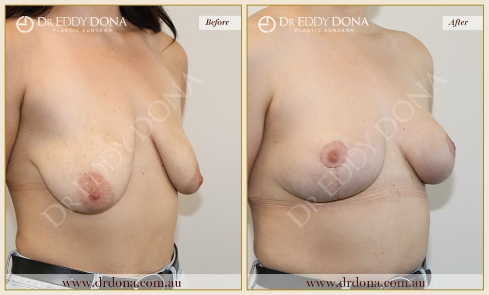 Dr Eddy Dona Breast Lift Before and After