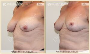 Dr Eddy Dona - Breast Lift Surgery - Before and After