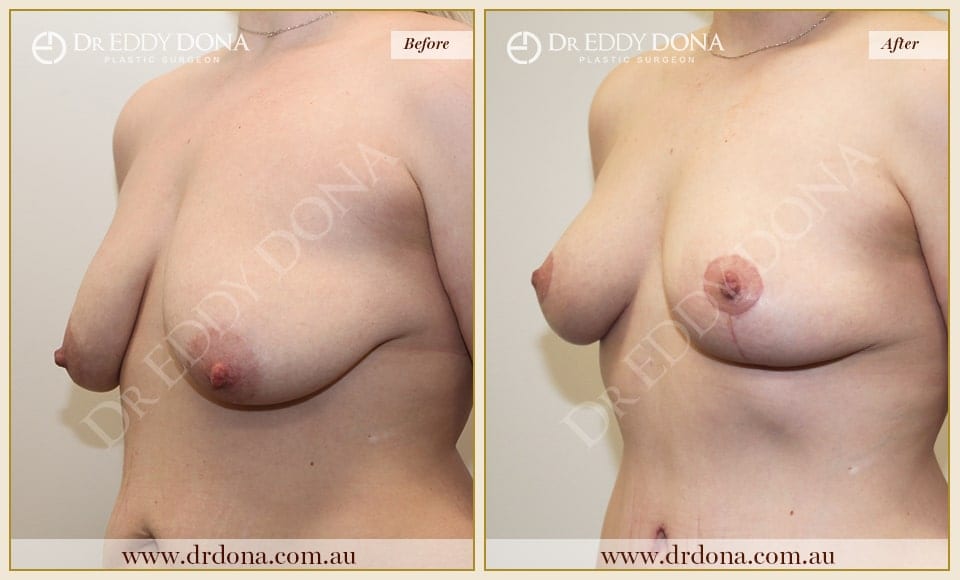 Dr Eddy Dona - Breast Lift Surgery - Before and After