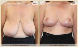 Dr Eddy Dona - Breast Reduction Before and After