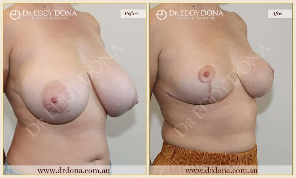 Dr Eddy Dona - Breast Reduction Before and After