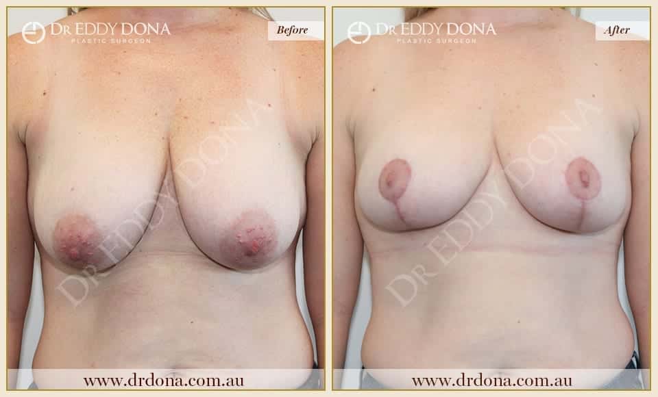 Dr Eddy Dona - Breast Reduction - Before and After