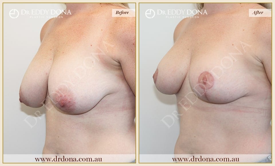 Dr Eddy Dona - Breast Reduction - Before and After