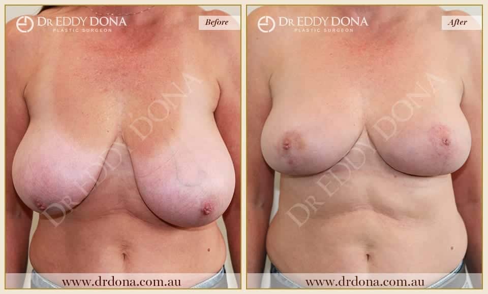 Dr Eddy Dona - Breast Reduction - Before and After