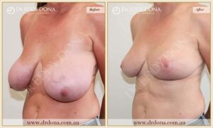 Dr Eddy Dona - Breast Reduction - Before and After