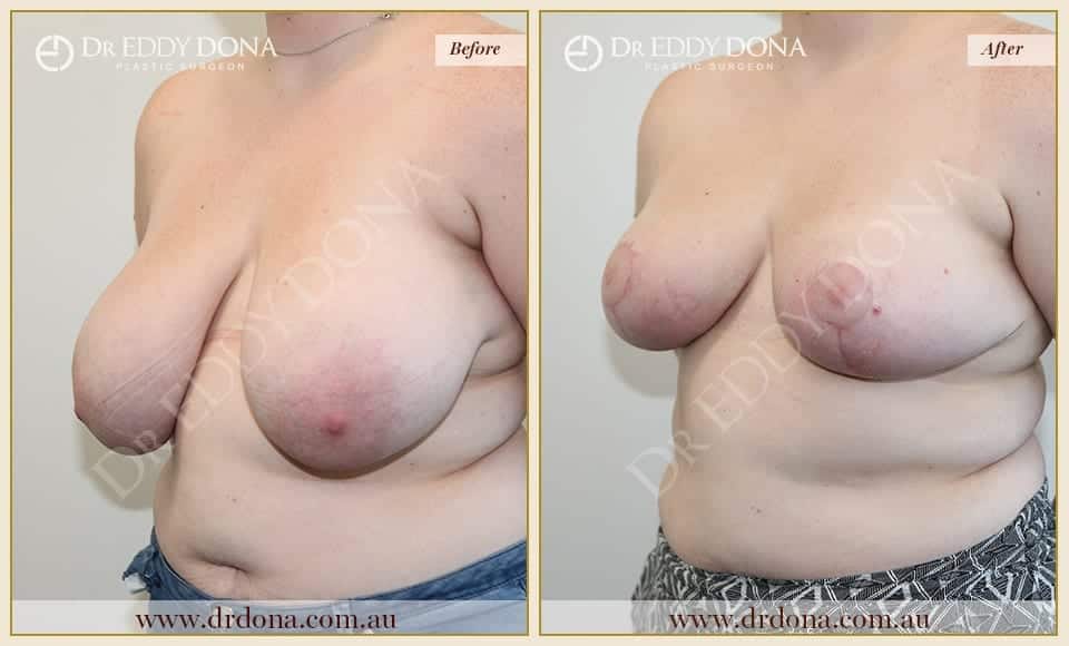 Dr Eddy Dona - Breast Reduction - Before and After