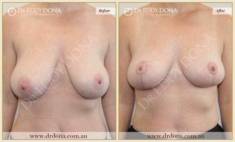 Dr Eddy Dona - Breast Reduction - Before and After