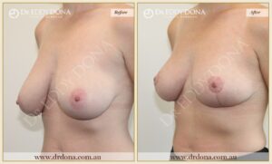 Dr Eddy Dona - Breast Reduction - Before and After