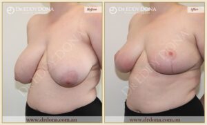 Dr Eddy Dona Breast Reduction Before and After