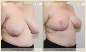 Dr Eddy Dona Breast Reduction Before and After