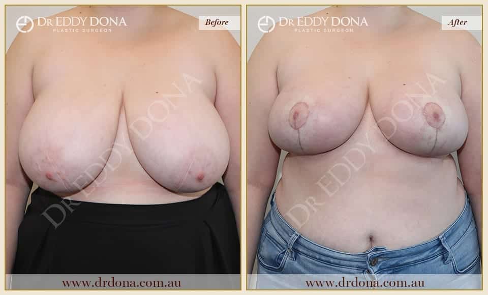 Dr Eddy Dona - Breast Reduction Before and After