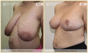 Dr Eddy Dona - Breast Reduction Before and After