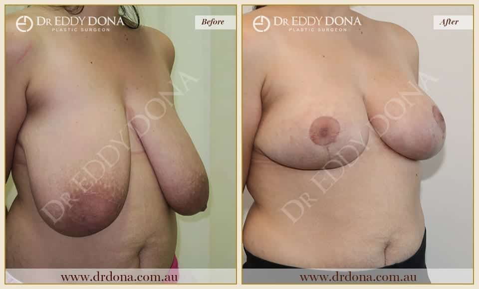 Dr Eddy Dona - Breast Reduction Before and After