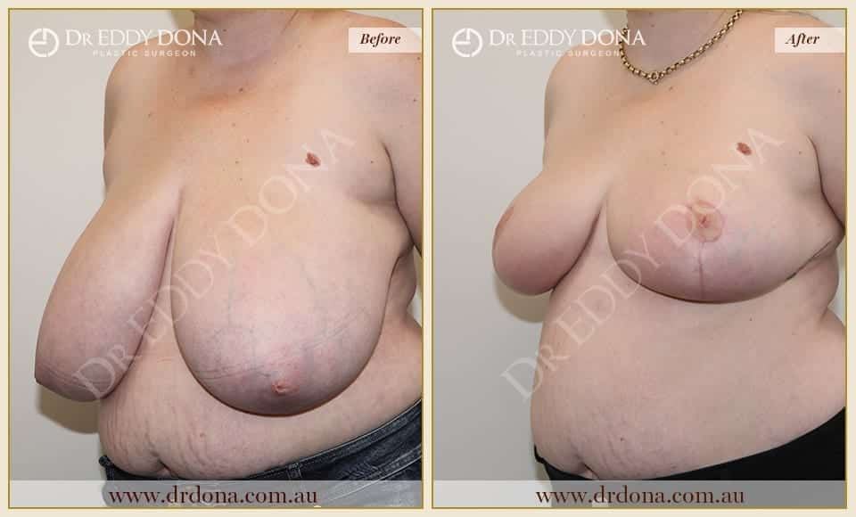 Dr Eddy Dona Breast Reduction Before and After