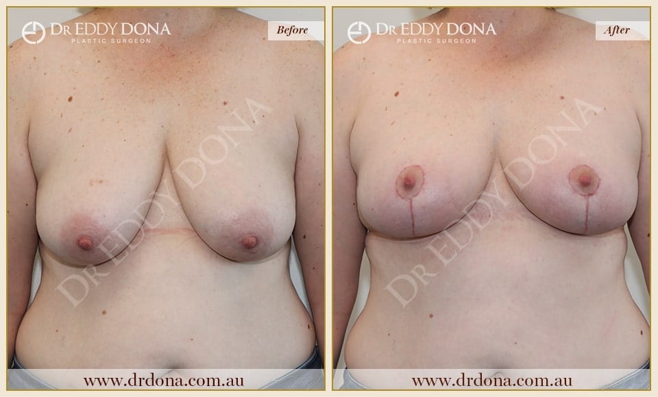 Dr Eddy Dona Breast Reduction Before and After