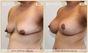 Dr Eddy Dona - Breast Lift and Implants Surgery - Before and After