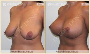 Dr Eddy Dona - Breast Lift and Implants Surgery - Before and After