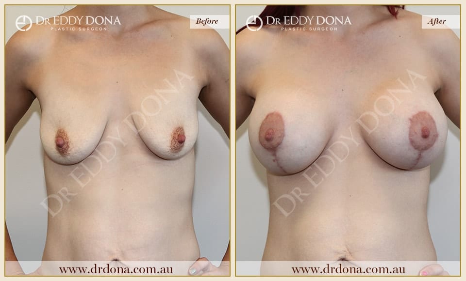 Dr Eddy Dona - Breast Lift and Implants Surgery - Before and After