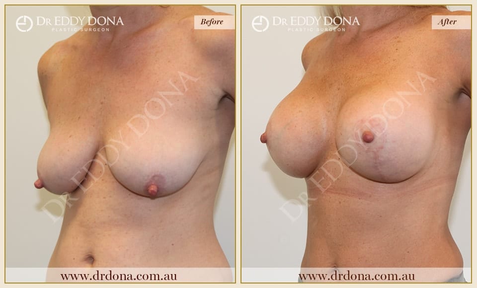 Dr Eddy Dona - Breast Lift and Implants Surgery - Before and After