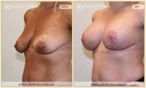 Dr Eddy Dona - Breast lift Surgery 420cc Before and After