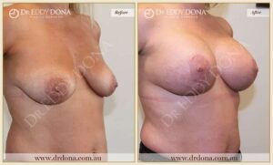 Dr Eddy Dona - Breast lift Surgery 420cc Before and After