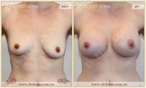 Dr Eddy Dona - Breast Lift and Implants Surgery - Before and After