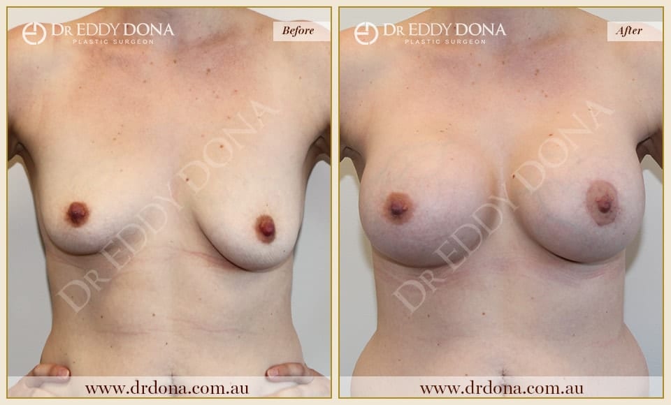 Dr Eddy Dona - Breast Lift and Implants Surgery - Before and After