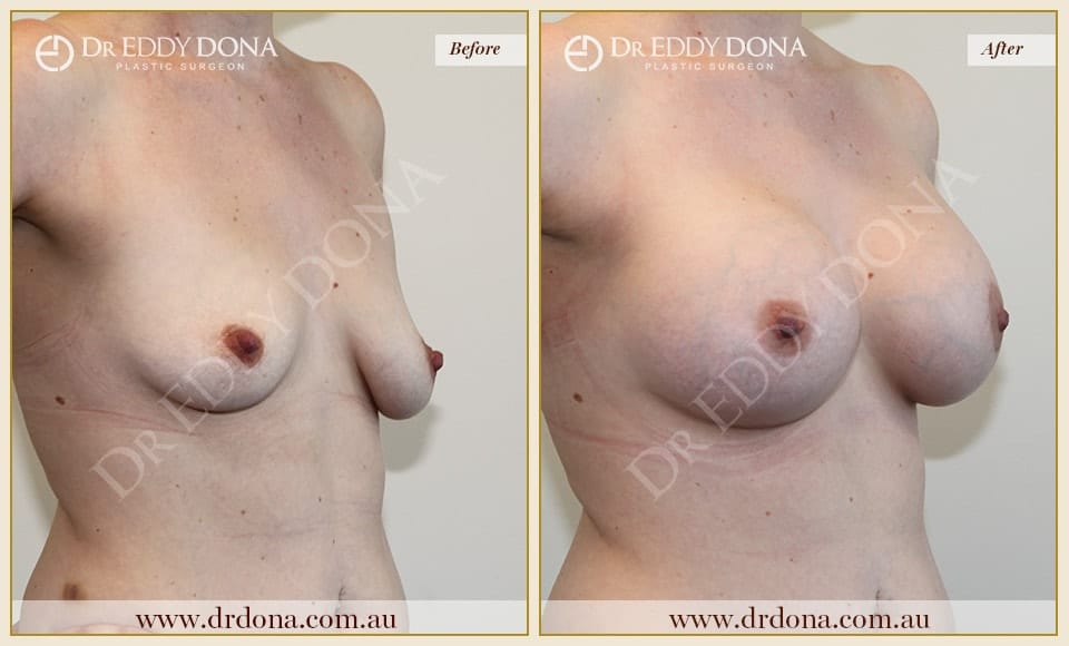 Dr Eddy Dona - Breast Lift and Implants Surgery - Before and After