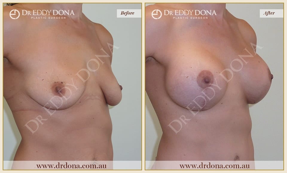 Dr Eddy Dona - Breast Lift and Implants Surgery - Before and After