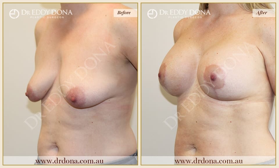 Dr Eddy Dona - Breast Lift and Implants Surgery - Before and After