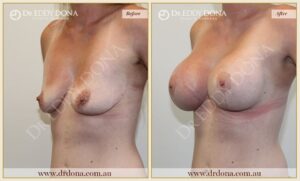 Dr Eddy Dona - Breast Lift and Implants Surgery - Before and After