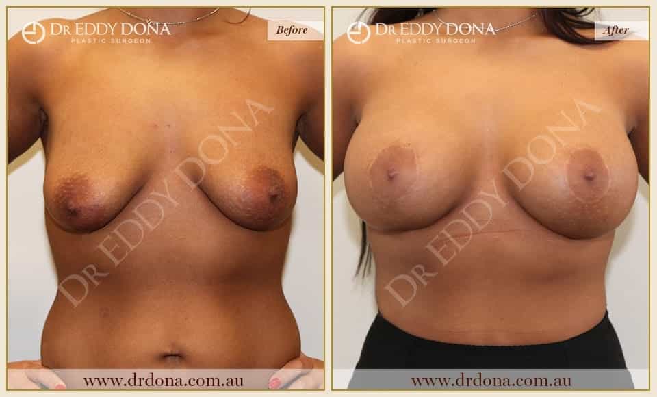 Dr Eddy Dona - Breast Lift and Implants Surgery - Before and After