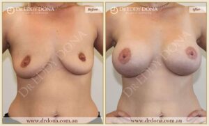 Dr Eddy Dona - Breast Lift and Implants Surgery - Before and After