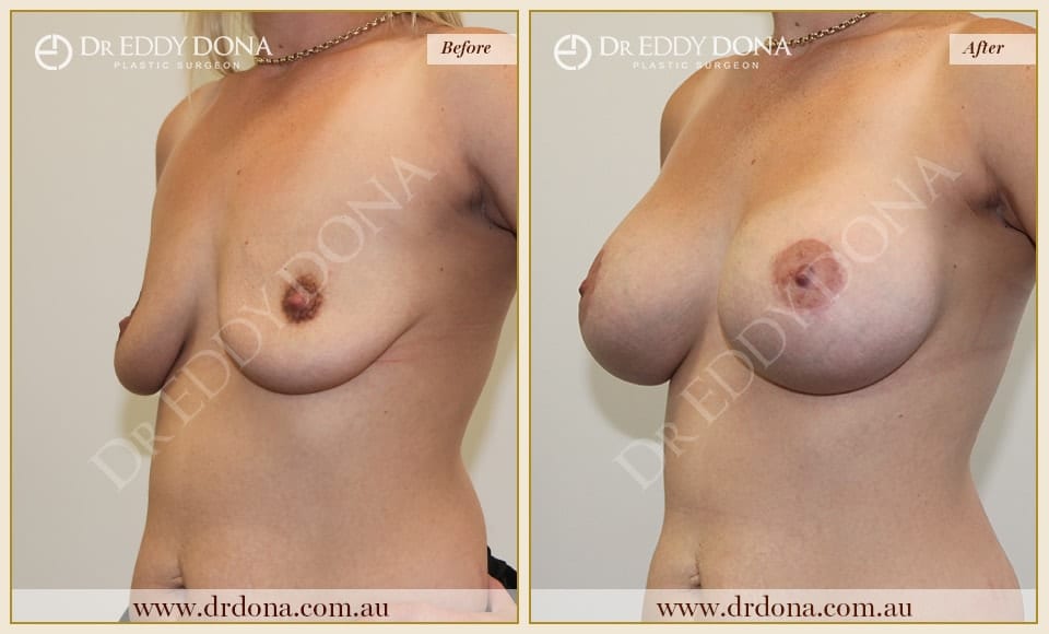 Dr Eddy Dona - Breast Lift and Implants Surgery - Before and After