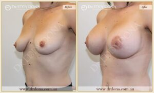 Dr Eddy Dona - Breast Lift and Implants Surgery - Before and After