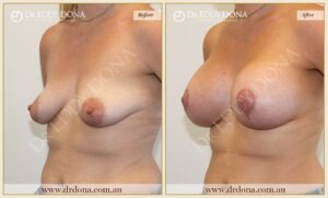 Dr Eddy Dona - Breast Lift and Implants Surgery - Before and After